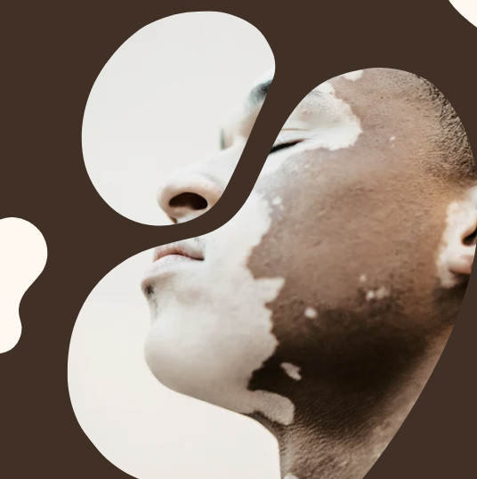 The Skin Microbiome and Vitiligo: What’s the Connection?